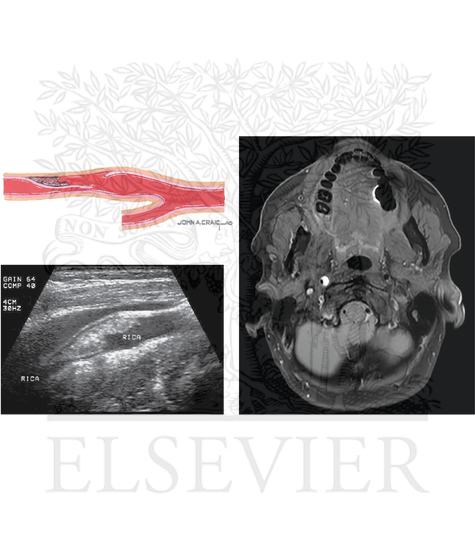 Watermarked preview of unlabeled image: Arterial Dissection