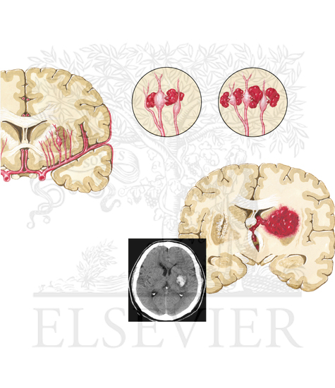 Hypertensive Intracerebral Hemorrhage: Pathogenesis