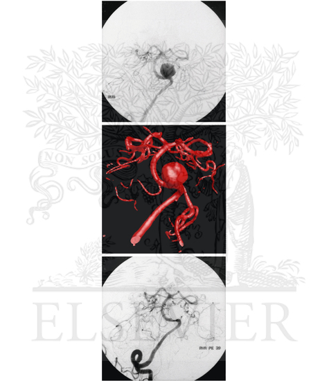 Interventional Radiologic Repair of Berry Aneurysm