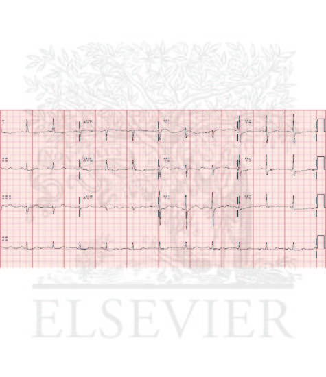 Changes Associated With Subarachnoid Hemorrhage