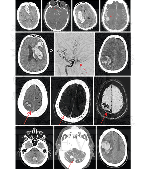 Typical CT (panel A) and susceptibility-weighted MR imaging (panels B and C) of ICH due to probable cerebral amyloid angiopathy