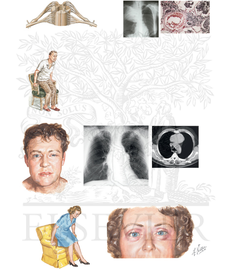 Paraneoplastic Disorder of Peripheral Nervous System