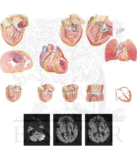 Cardiac Embolism