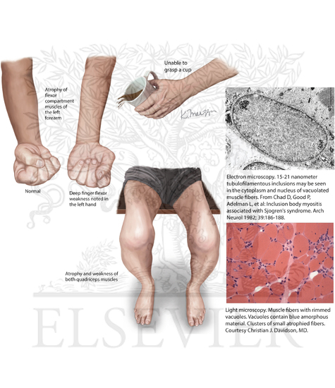 Inclusion Body Myositis