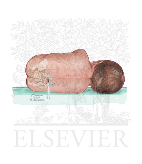 Watermarked preview of unlabeled image: Lumbar Puncture in Infant