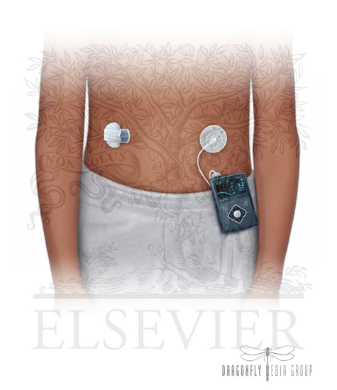 Diabetes: Continuous glucose monitor (CGM)