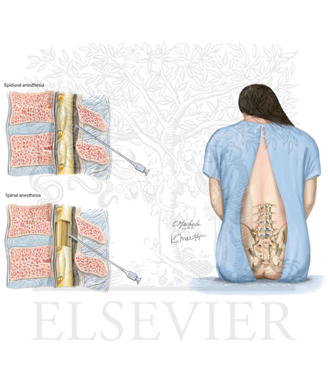 Epidural Anesthesia and Spinal Anesthesia