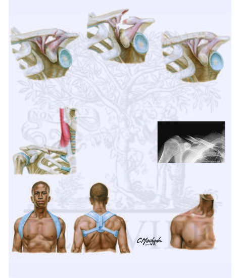 Watermarked preview of unlabeled image: Clavicular Fractures