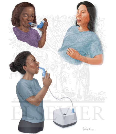 Watermarked preview of unlabeled image: Asthma and Emboli