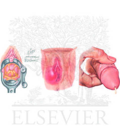 Urogenital manifestations of gonorrhea in men and women