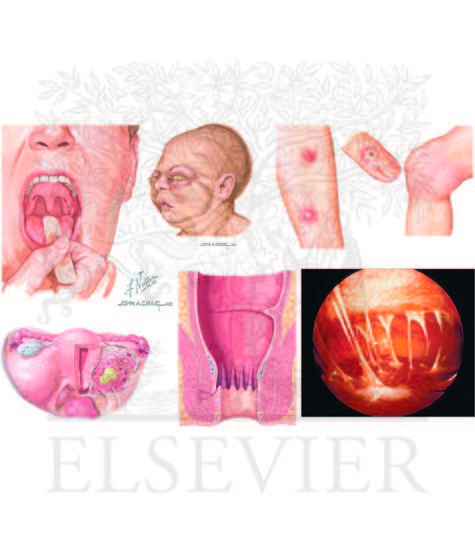 Watermarked preview of unlabeled image: Extra-genital manifestations of gonorrhea