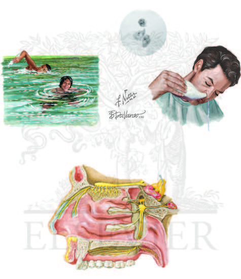 Exposures leading to infection with Naegleria fowleri.