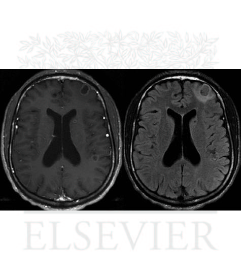 MRI demonstrates intraparenchymal cysts, one with pronounced perilesional edema