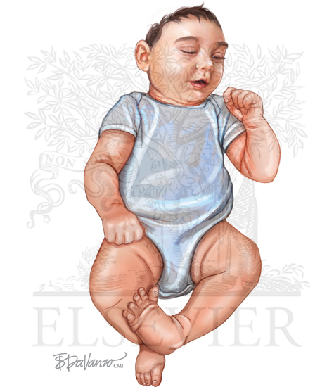 Specific clinical findings in infants with congenital Zika virus infection