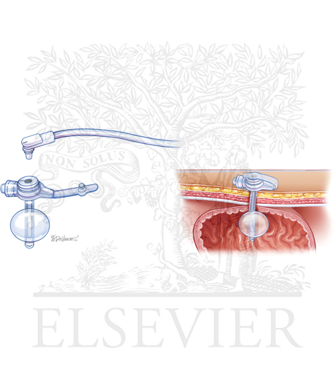 Button gastrostomy tube