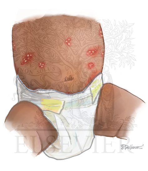 Neonatal Herpes Simplex Virus Vesicles