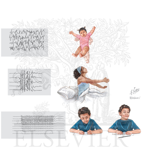 Common Epilepsy Syndromes