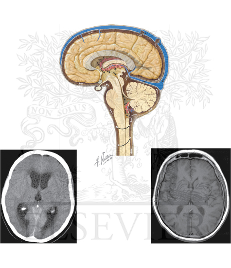 Herniation Syndromes