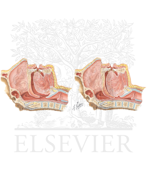 Anatomic representation of upper airway obstruction resulting in diminished airflow and disrupted ventilation