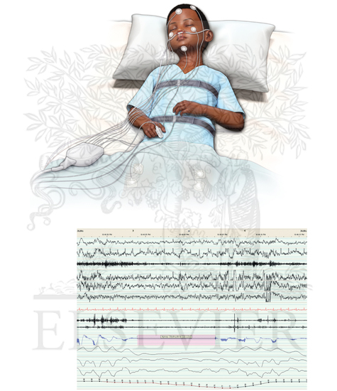 Watermarked preview of unlabeled image: A, Pediatric polysomnogram; B. Epoch