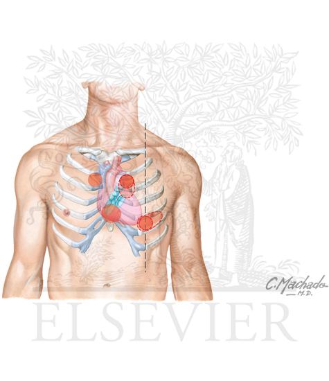 Watermarked preview of unlabeled image: Cardiac auscultation: correlation of murmurs and other adventitious sounds with underlying pathophysiology