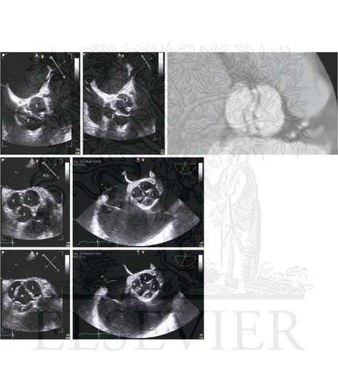 Transesophageal Echocardiography and CT Images of Aortic Valves