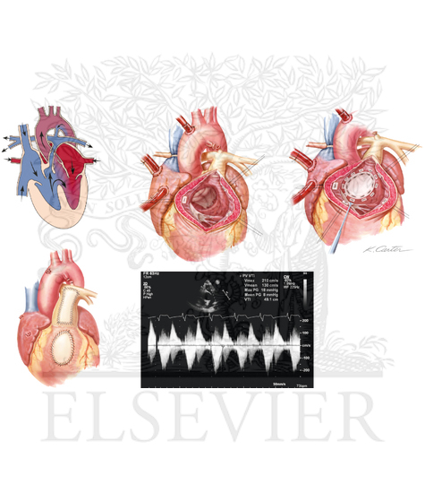 Watermarked preview of unlabeled image: Tetralogy of Fallot (TOF)