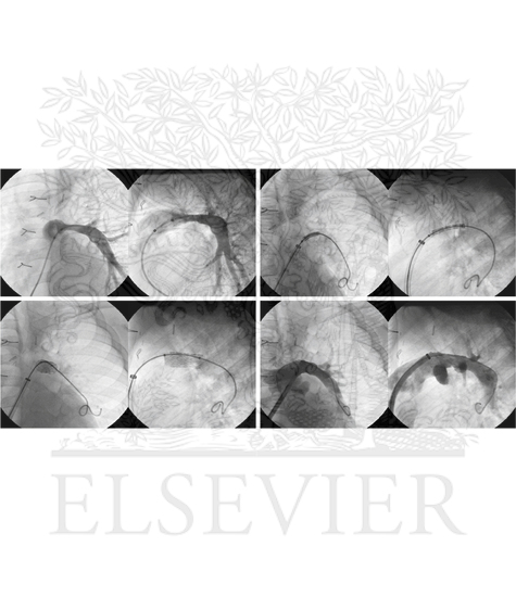 Watermarked preview of unlabeled image: Left Pulmonary Artery Stenosis Stepwise Stent Implantation