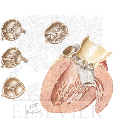 Degenerative Calcific Aortic Valve Stenosis May Originate From Slow Calcification of a Trileaflet Aortic Valve, or Be Hastened by Bicuspid or Rheumatic Pathology