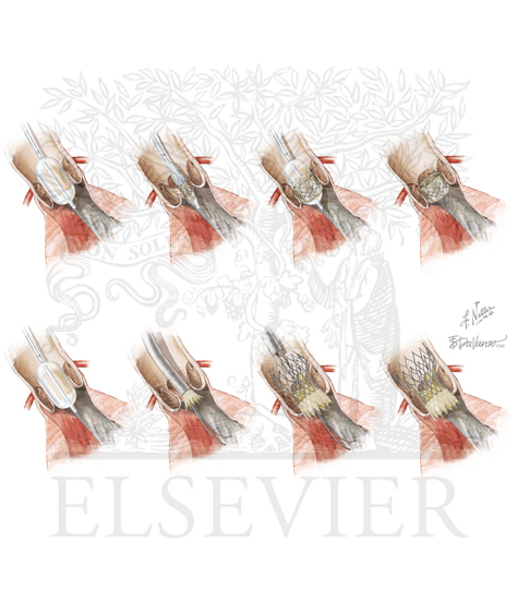 Percutaneous Aortic Valve (Edwards Sapien and CoreValve) Replacement