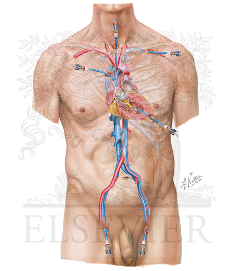 Approaches to Transcatheter Aortic Valve Replacement