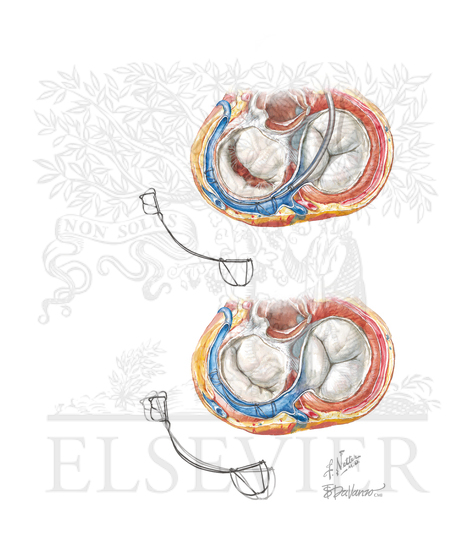 Watermarked preview of unlabeled image: The Carillon Mitral Contour System for a Percutaneous Approach to Mitral Annuloplasty