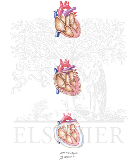 Watermarked preview of unlabeled image: Comparison of Normal and Pathological Intracardiac Pressures