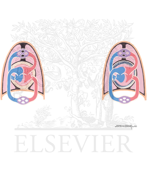 Watermarked preview of unlabeled image: Comparison of Blood Flow in Constrictive Pericarditis and Pericardial Tamponade