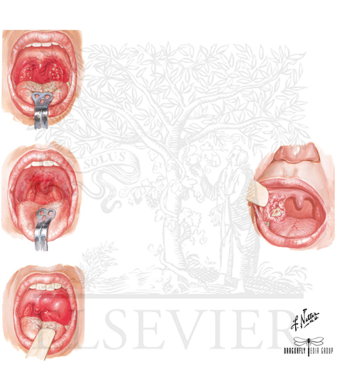 Differential Diagnosis of Sore Throat