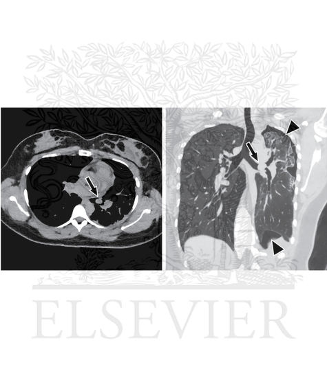 Watermarked preview of unlabeled image: Endobronchial Mass