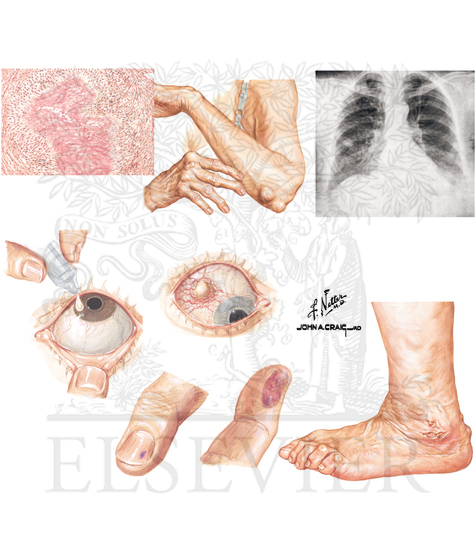 Watermarked preview of unlabeled image: Extraarticular Manifestations of Rheumatoid Arthritis