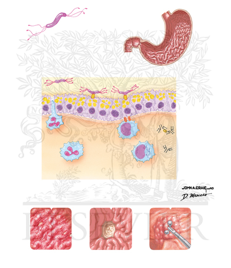 Watermarked preview of unlabeled image: Helicobacter pylori