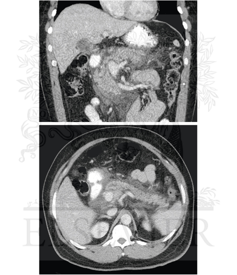 Radiographic Image of Pancreatitis With Edema of the Pancreas as Well as Around the Organ
