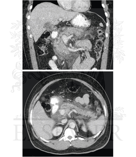 Watermarked preview of unlabeled image: Radiographic Image of Pancreatitis With Edema of the Pancreas as Well as Around the Organ