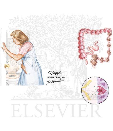 Irritable Bowel Syndrome (IBS)