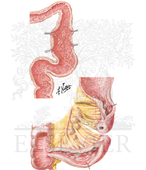 Inflammatory Bowel Disease