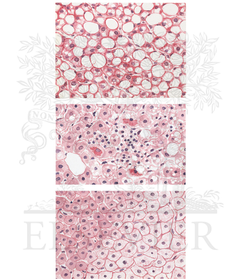 Pathological Findings in Alcohol-associated Steatosis and Steatohepatitis
