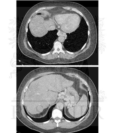 Watermarked preview of unlabeled image: Radiographic Findings in Cirrhosis