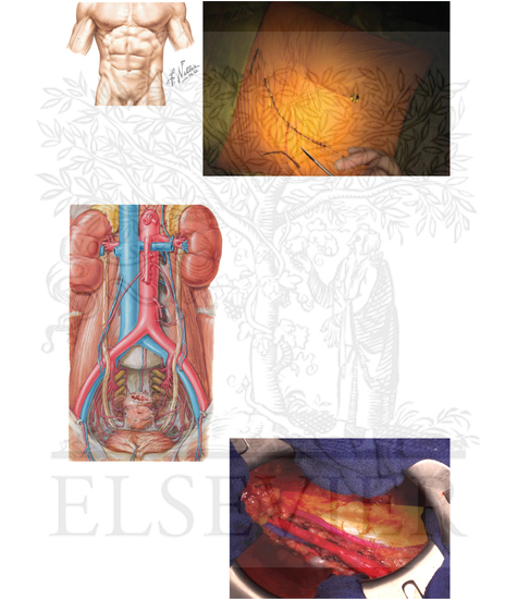 Kidney transplantation