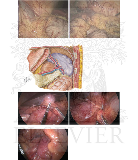 Hepatic and splenic flexures