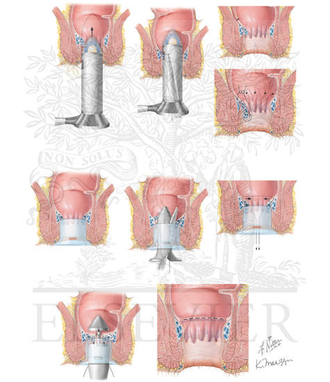 A) Techniques of Doppler-guided
hemorrhoidal ligation and mucopexy. (B) Stapled
hemorrhoidopexy