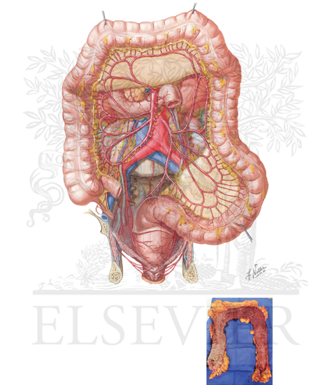 (A) Arteries of the colon. (B) Mucosal changes in patient with medically refractory ulcerative colitis