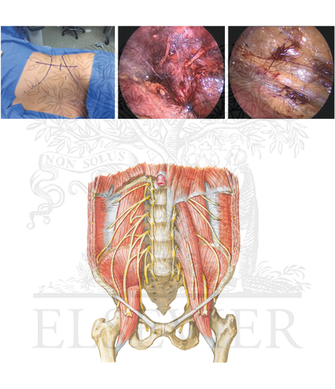 Laparoscopic triple neurectomy