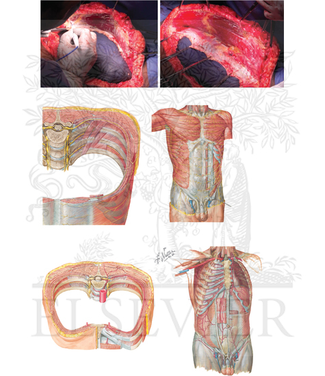 Watermarked preview of unlabeled image: Rives-Stopparetrorectus dissection